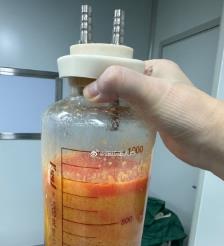 揭阳水动力吸脂手术要做多久？